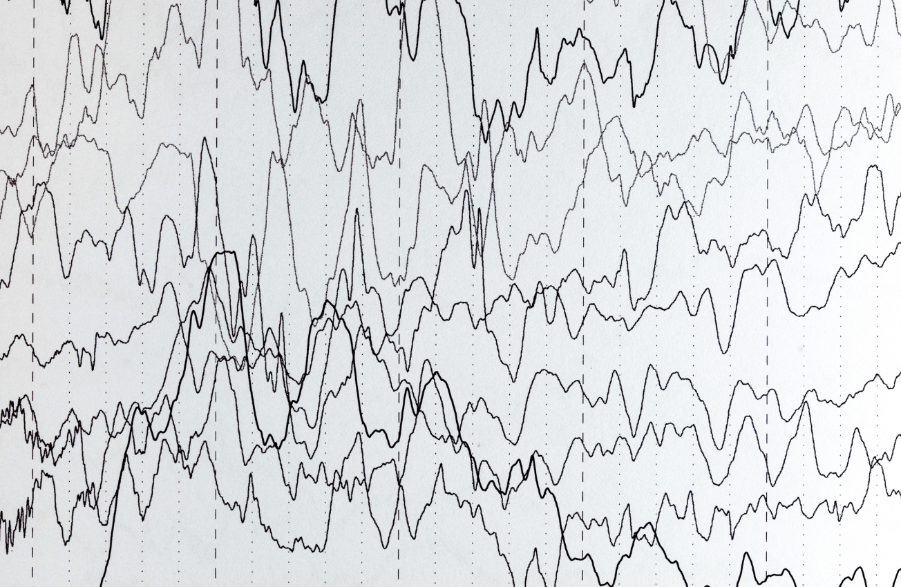 qEEG Brain Mapping